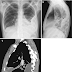 Loculated Pleural Effusion Meaning / Chest Radiograph Showing A Left Sided Loculated Pleural Effusion Download Scientific Diagram / Diﬀerentiation of loculated eﬀusions from solid.