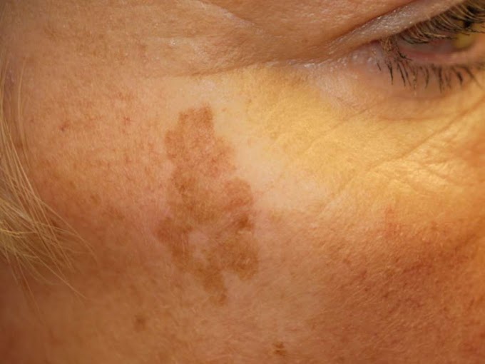 Skin Cancer Removal - Prostate Cancer Treatment Vs. Removal Surgery: Side / There are a number of different treatments doctors recommend.