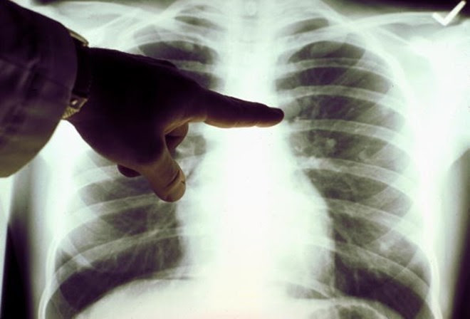 Criadas nanopartículas inteligentes que matam células cancerígenas