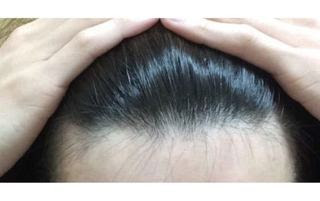 驚愕 頭皮丸見えのスカスカハゲが1ヵ月でフサフサに 石田純一絶賛の育毛剤が凄い