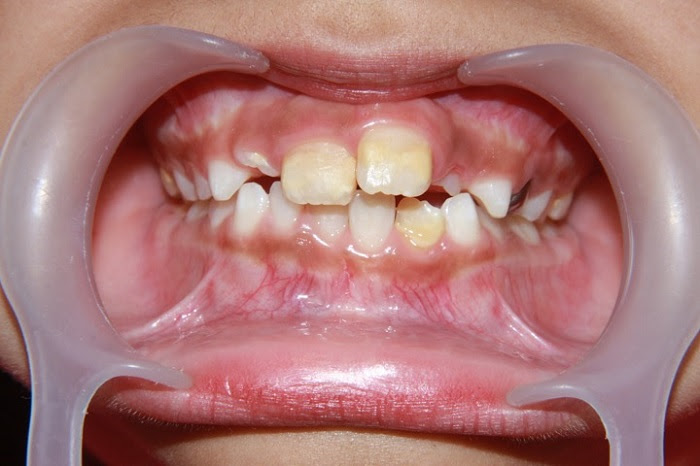 Tiene Tu Hijo Manchas Blancas O Marrones En Los Dientes Espacio Dental Jaen