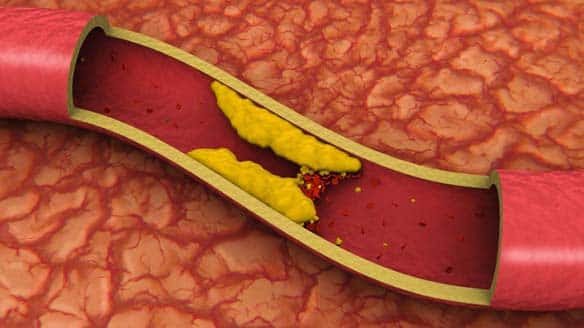 High cholesterol levels can lead to a build-up of plaque in the arteries, which can increase your risk of heart attack and stroke.