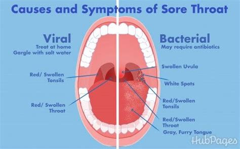 symptoms   treatment   sore throat  night
