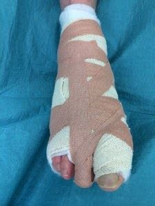 Plantar fasciitis is a pain disorder which affects the heel and the bottom of the foot and is the most common cause of foot pain. Plantar Fibroma and Fibromatosis | Mr Malik at LFAC