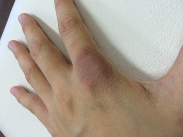 スポーツ障害治療紹介 打撲
