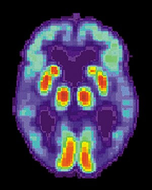 PET scan of a human brain with Alzheimer's disease