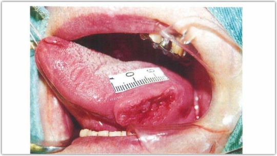 舌にみられる粘膜疾患について 習志野市の歯科スマイルドクター 医療法人社団ほほえみ会スマイルデンタルクリニック 習志野市