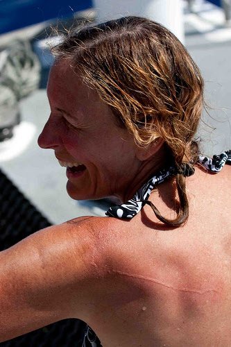 Portuguese Man O War. A Man O#39;War Sting while out in