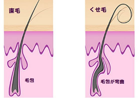 天然パーマやくせ毛を直す方法 髪の毛にいい食べ物で若ハゲ克服対策