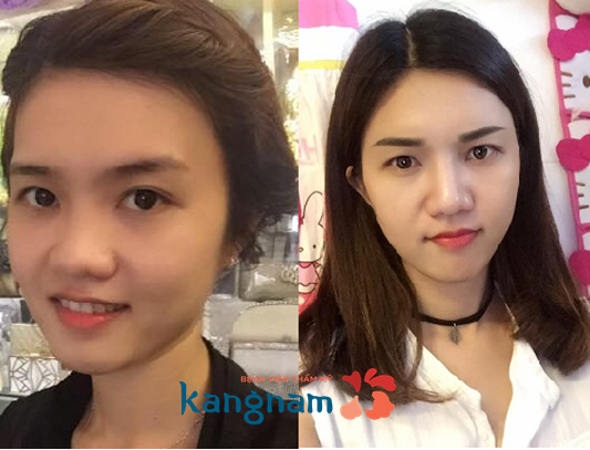 Nâng mũi bằng mỡ tự thân 3