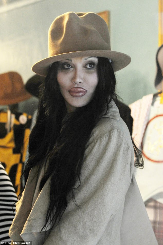 Burns, pictured, underwent around 200 surgeries over the space of two years to fix lip augmentation surgery
