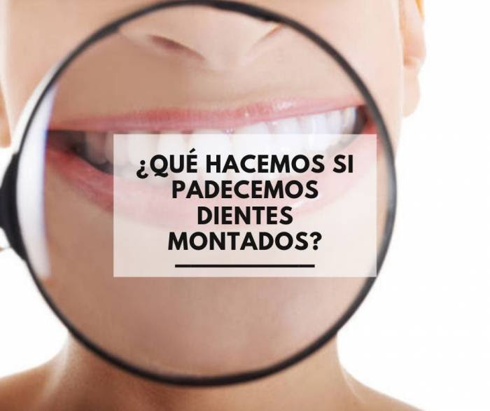 Que Hacemos Si Padecemos Dientes Montados Alonso Dental