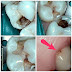 How Long Does It Take To Fill A Cavity Reddit