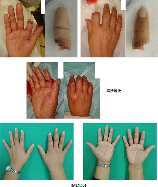 整形外科専門病院 脊損 弘前記念病院 股関節の手術