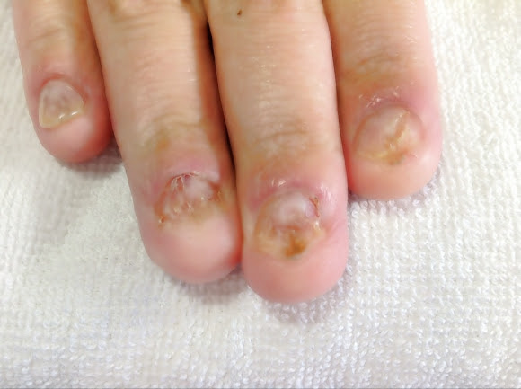 深爪矯正 巻き爪矯正 モモネイルサロン ネイルスクール 北九州市若松区