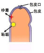 包茎かな