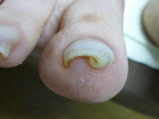 札幌巻き爪専門 フットケアサロンたかはし 巻き爪の原因