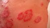 Skin Cancer Mole On Hand : Rash on Palms and Soles (Pictures) - (2020 - Updated) / Skin cancer is one of the most common types of cancer.