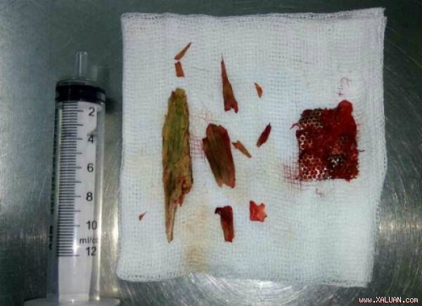  Các dị vật được lấy ra ngoài. Ảnh: C.P