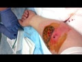 Infected abscess on tattoo
