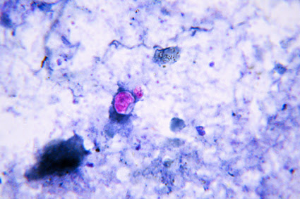 Fig. 7. Same microscopic field as in Fig. 6. Higher magnification (100x objective) shows a ...