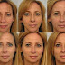 How Long Does It Take For Filler To Settle Under Eyes
