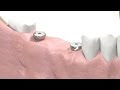 Dental Implantology - Prosthetic Animation: Bridge-Work (Open Tray Technique)