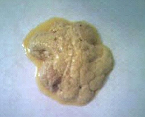 Steatorrhea - Definition, Pictures, Symptoms, Causes ...