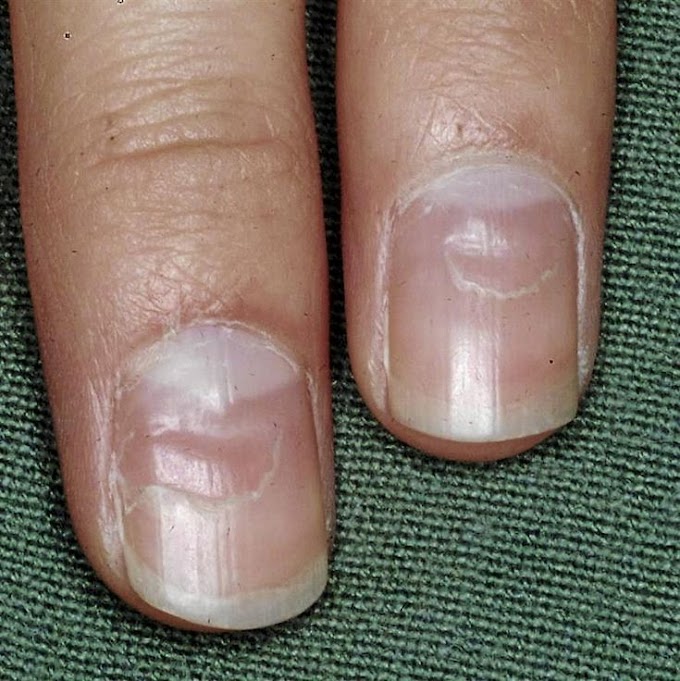 Skin Cancer Under Finger Nail : Dirty Fingernails Under a Microscope (Disgusting !!) - YouTube / Skin and nails you may have minor skin problems while you are having chemotherapy, such as redness, rashes, itching, peeling, dryness, acne, and increased sensitivity to the sun.