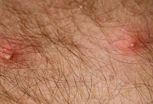 Fire Ant Bites Picture Image on MedicineNet.com