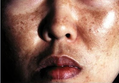 Image result for JERAGAT ATAS BIBIR