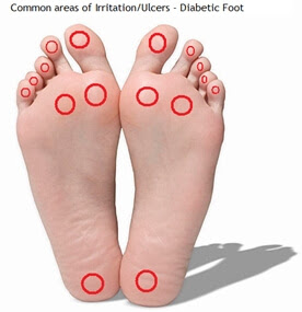 Neuropathy - Academy Foot and Ankle - Southlake, Hurst, Keller (Fort ...