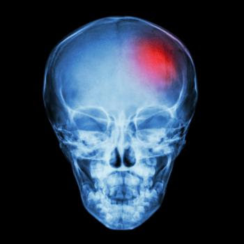 An X-ray of a stroke in a child