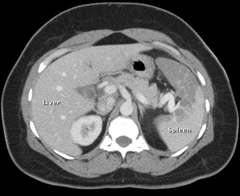 Images In Emergency Medicine Splenic Infarction Due To Sickle Cell Trait After Climbing Mt Fuji The Western Journal Of Emergency Medicine