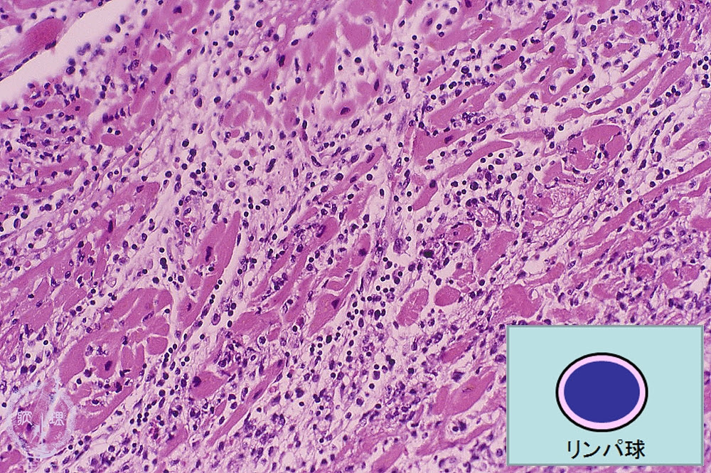 3.Cardiovascular system (3) Viral myocarditis|Pathology ...