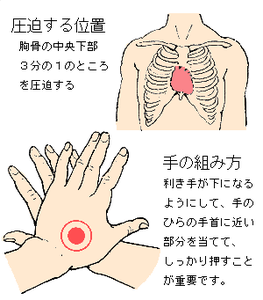 救急蘇生法のc A B 病気について 循環器病について知る 患者の皆様へ 国立循環器病研究センター病院