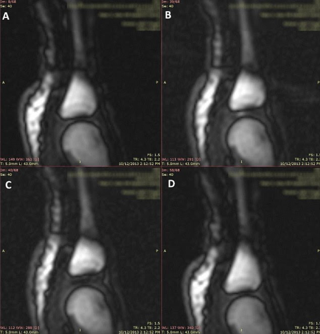 These MRI scans show the finger joints before the hand was cracked (A), and as the hand is being cracked, but just before the cavity forms (B), just after they were cracked (C), and the period after it was cracked (D)
