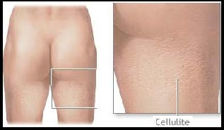 cellulite glutei