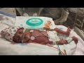 Plus de 400 feto bebe 5 meses prematuro 198198