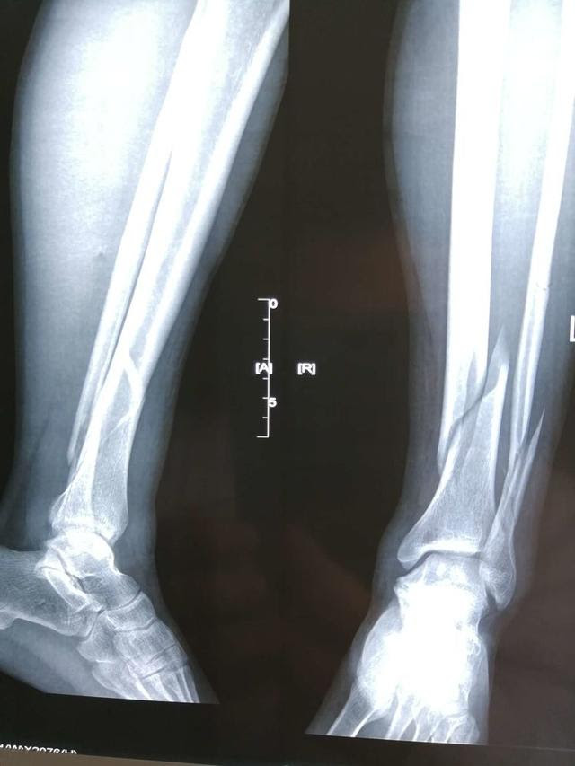 专家级髓内钉治疗胫腓骨远端骨折可以做到极致 胫骨