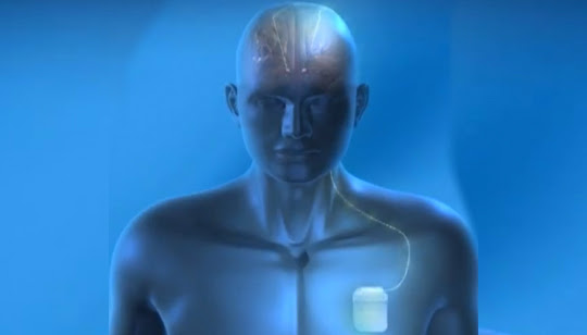 Nuevo marcapasos para tratar el Alzheimer → alzheimer Marcapasos Cerebro 