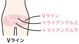 Vio脱毛の教室 専門家がオススメする形や痛み対策など全知識