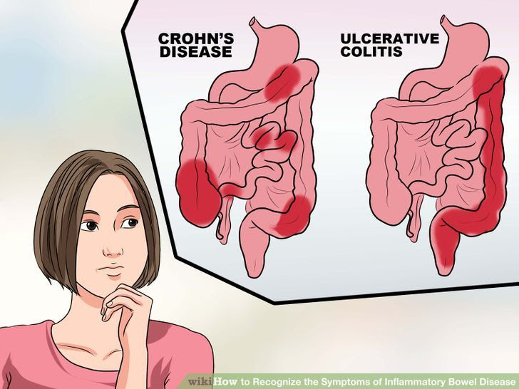 Recognize the Symptoms of Inflammatory Bowel Disease Step 15 Version 2.jpg
