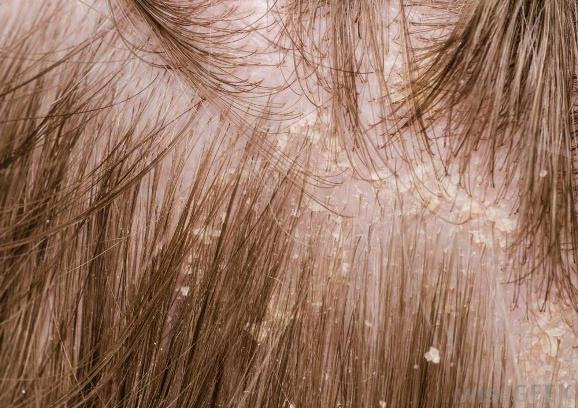home remedies for dandruff