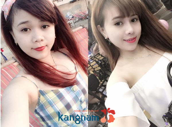nang-mui-co-bi-keo-mat-khong-3