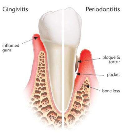 Home remedies for gum disease | News | Dentagama