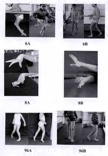 脳性麻痺英語版 Cerebral Palsy Orthopaedic Selective Spasticity Control Surgery