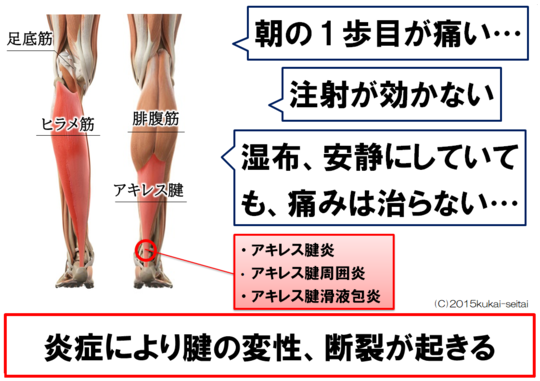 アキレス腱炎の改善方法とセルフケア 治療院空海 岐阜県羽島市