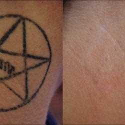 Mad Dog Tattoo Removal - Tattoo Removal Before and After - Austin, TX ...