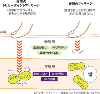 急な 痛み 疲れに効果 トリガーポイントと筋膜アプローチ 青山 外苑前でマッサージ 鍼 コンディショニングならkj北青山治療院